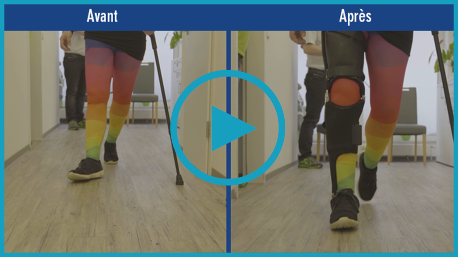 Vidéo de patient vidéo d’une patiente atteinte de sclérose en plaques SEP. Comparaison avant/après de la démarche sans traitement dispositif médical et avec une orthèse cruro-pédieuse KAFO sur mesure avec articulation de cheville modulaire NEURO VARIO-SPRING procurant davantage d’assurance lors de la station debout et de la marche.