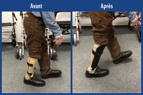 Vidéo de patient vidéo d’un patient avec une amputation amputation partielle du pied selon Chopart suite à une inflammation du pied. Comparaison avant/après de la démarche avec appareillage dispositif médical prothèse rigide sans articulation de cheville et une prothèse partielle de pied AFO sur mesure avec articulation de cheville modulaire NEURO SWING pour un déroulement complet.